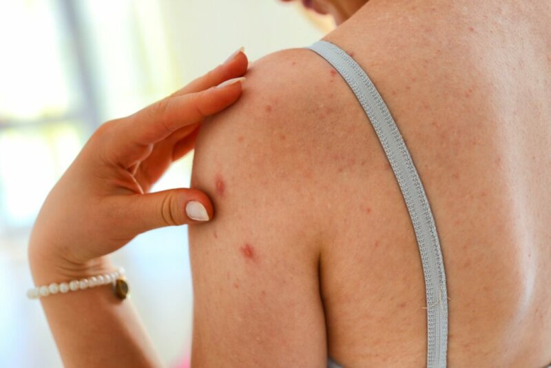 Preventing Shingles, The Best Way to Decrease Your Risk of Shingles Related Stroke